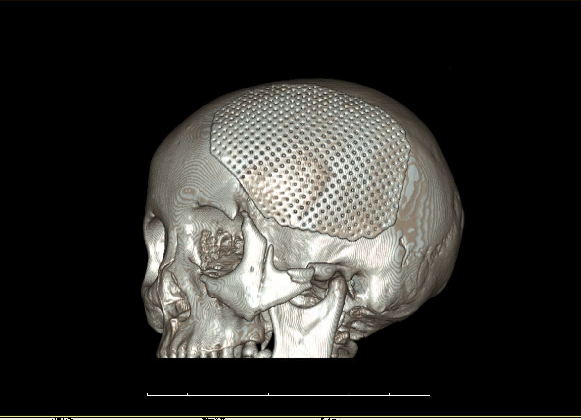 顱骨修補術患者須知
