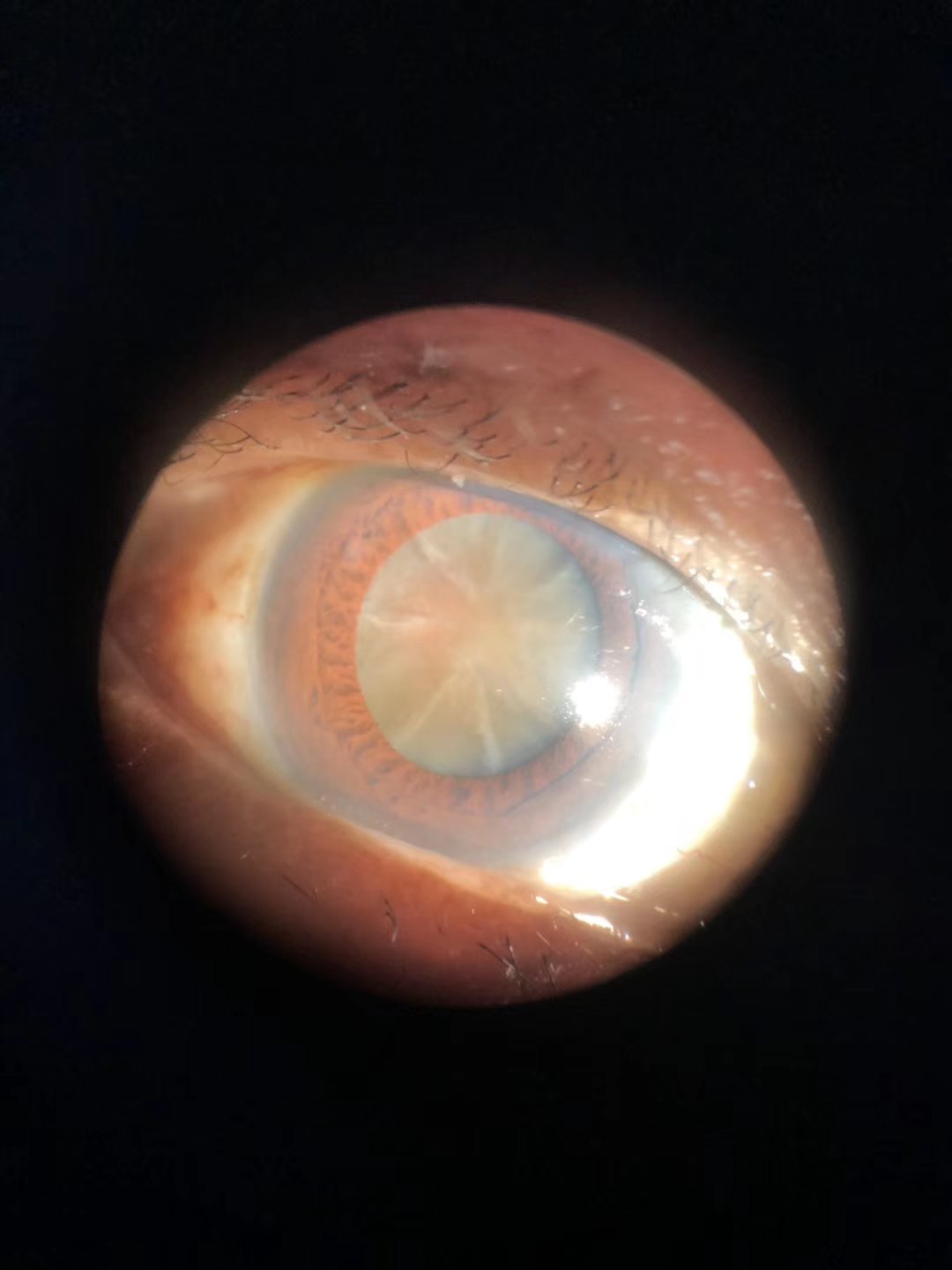 高端晶体手术和icl手术及激光手术漫谈 近视眼手术 近视眼手术手术