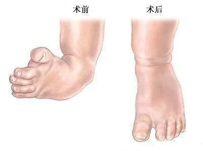 先天性马蹄内翻足怎么产生的 先天性马蹄内翻足 病因 先天性马蹄内翻足怎么产生的 先天性马蹄内翻足 病因