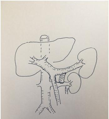 保留脾脏的脾肾静脉人工血管搭桥分流术示意图