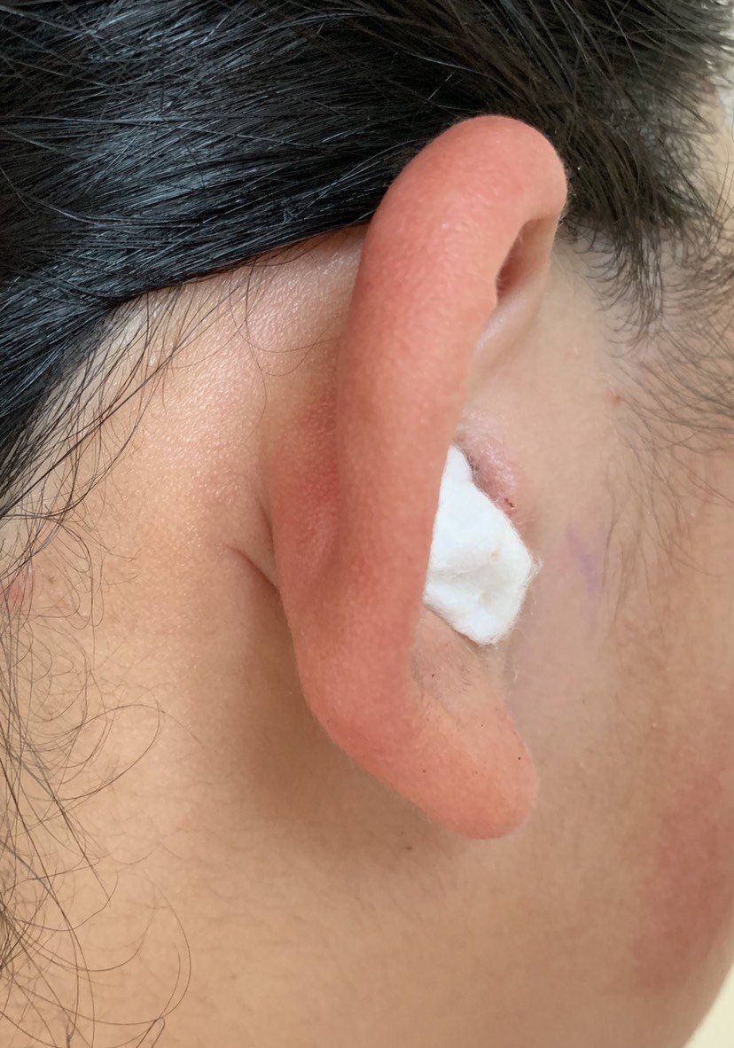 鼓膜穿孔耳内镜微创修补技术