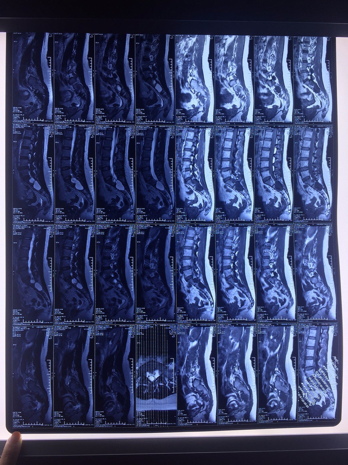 【案例】骶管囊肿的手术治疗 - 好大夫在线