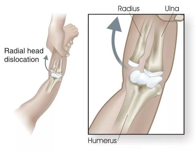 小儿哭闹 手臂不敢动 警惕桡骨小头半脱位 桡骨头半脱位 病因 症状 预防 日常护理 好大夫在线 小儿哭闹 手臂不敢动 警惕桡骨小头半脱位 桡骨头半脱位 病因 症状 预防 日常护理 好大夫在线