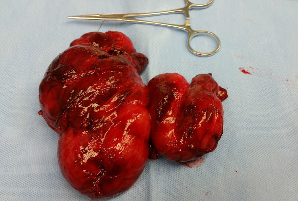 切除的全甲状腺标本(含左右两侧甲状腺及峡部)本文是严佶祺版权所有