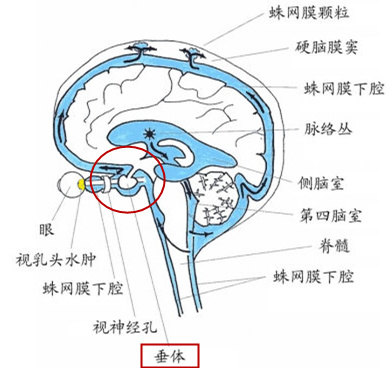 垂体瘤手术后 警惕脑脊液鼻漏和颅内感染