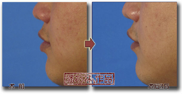 厚唇/重唇修薄整形手术_唇部整形_治疗介绍_治疗准