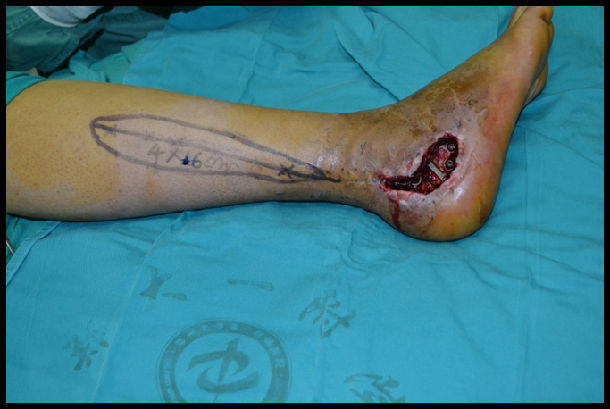 小腿外侧皮瓣 - 好大夫在线