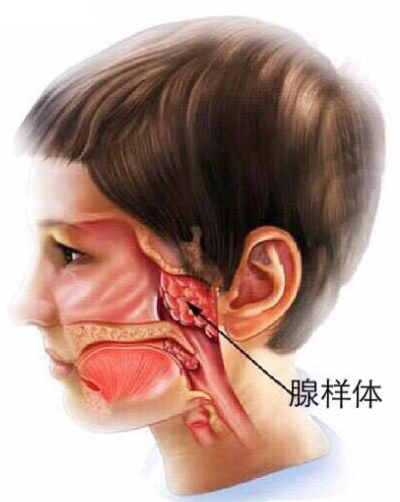 长期的睡眠不安通气受限,会导致慢性脑缺血缺氧症状和腺样体面容,易