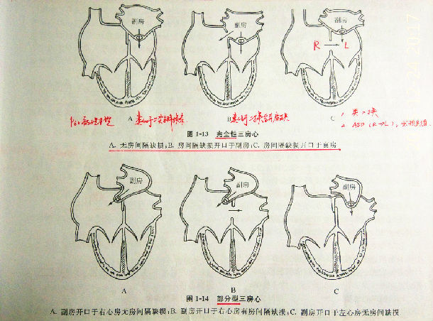 先天性心脏病 三房心的诊治