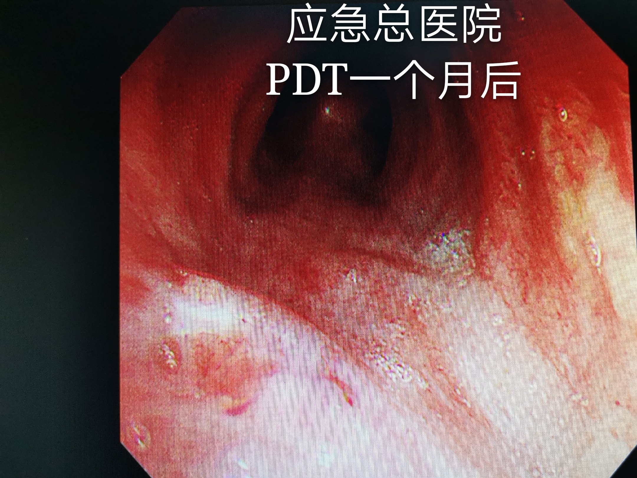 光动力疗法治疗气管腺样囊性癌_气管肿瘤_气管肿瘤治疗方式 - 好大夫