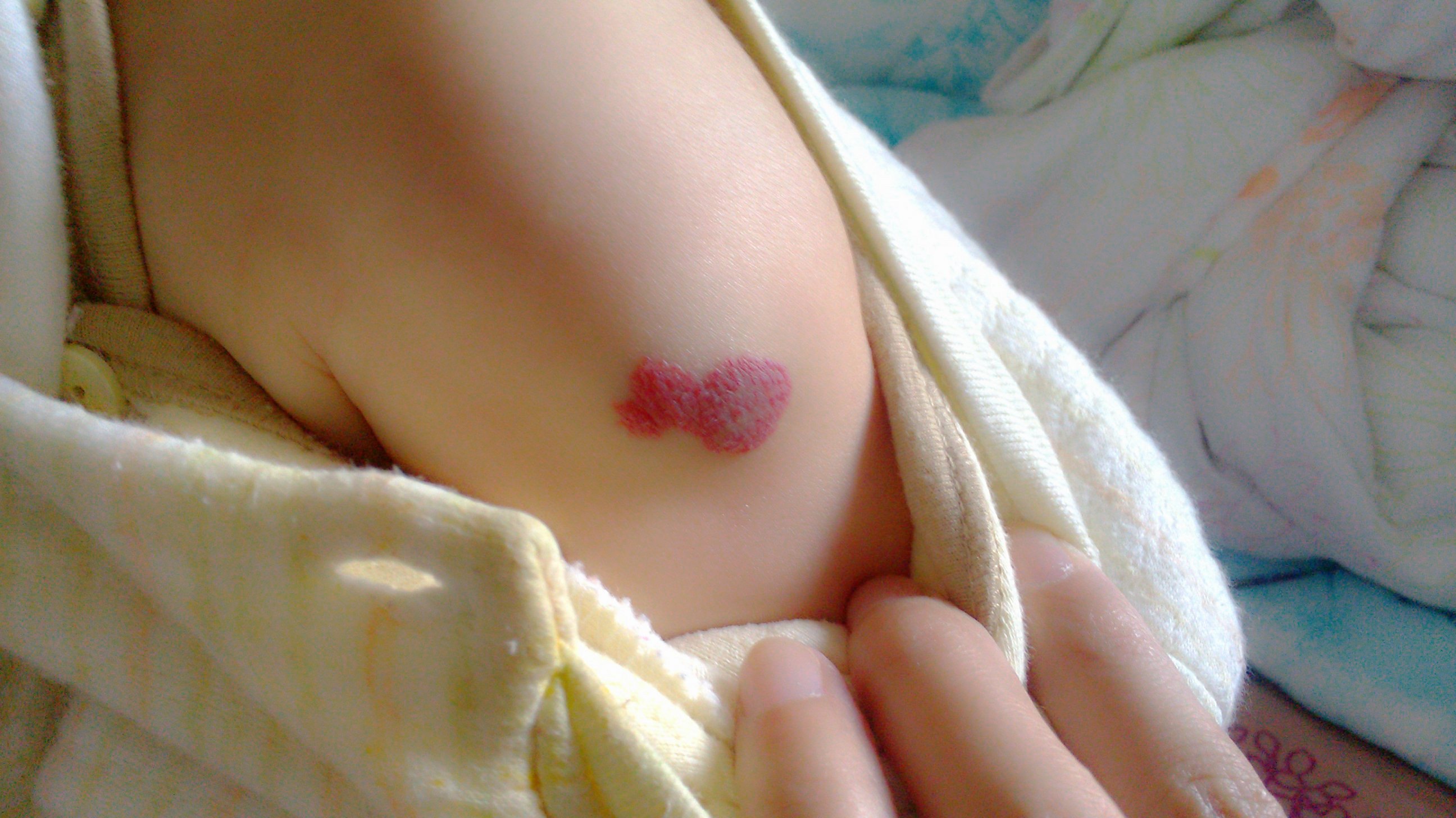 小儿血管瘤 - 好大夫在线