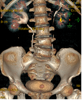 图-2:ctu显示右侧肾盂输尿管交界处狭窄,右 肾积水 .