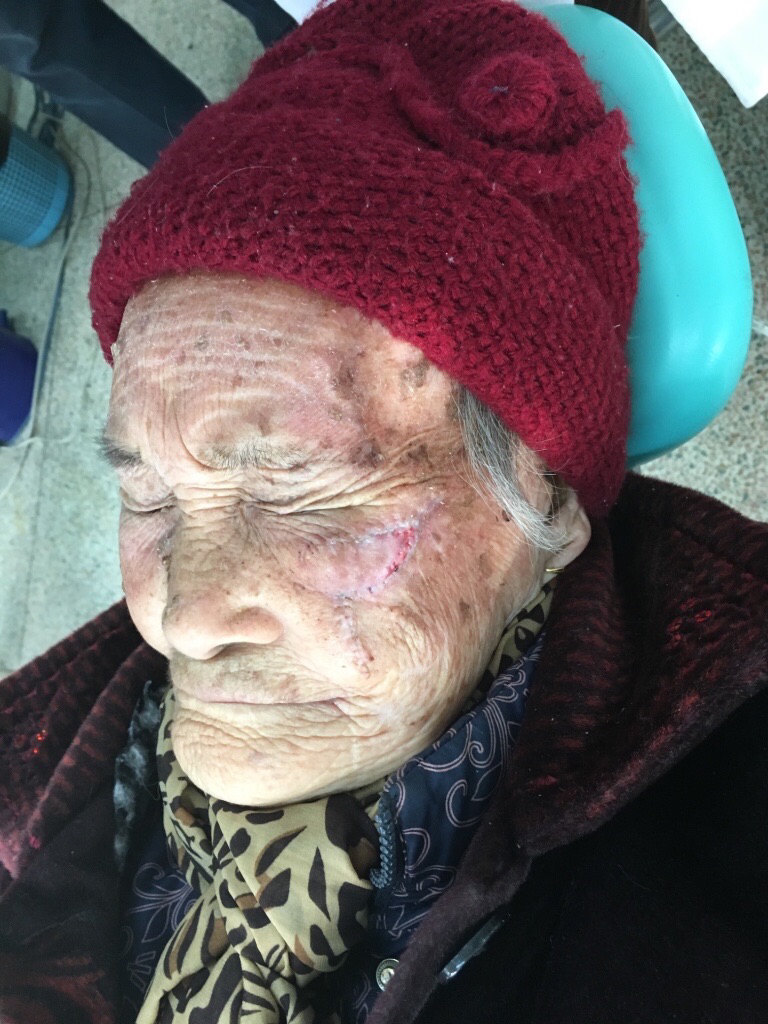 面部基底细胞癌 - 好大夫在线