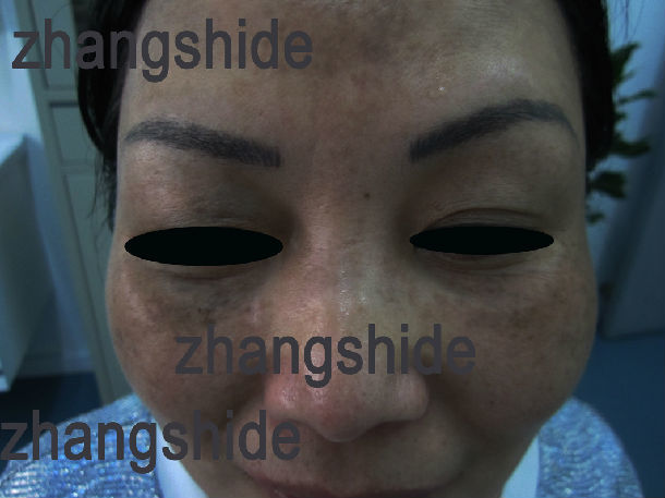 医生手记之化妆品导致的黑斑_治疗方法 - 好大夫在线