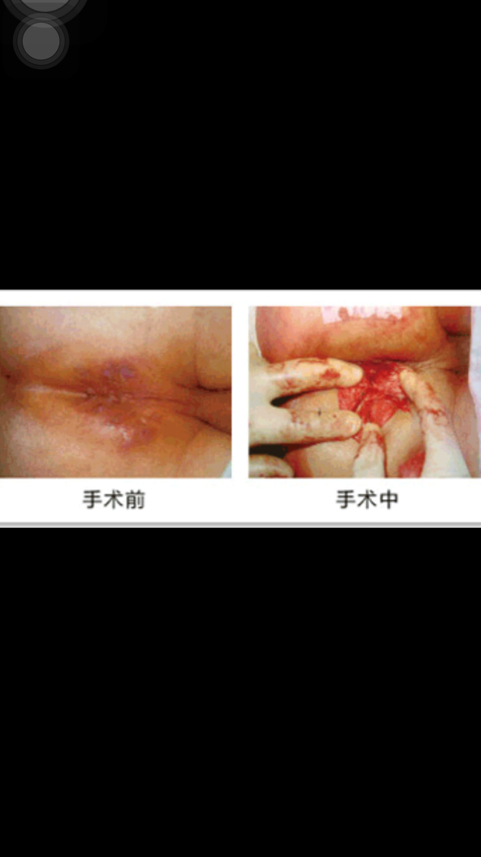 肛周脓肿和肛瘘的病因诊断和治疗