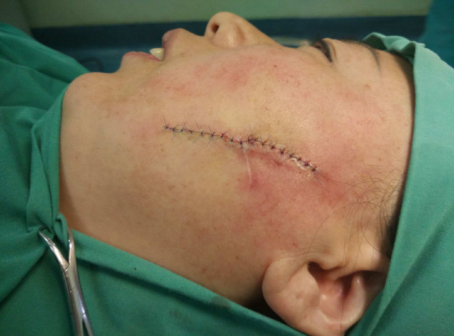 面部瘢痕切除病例 - 好大夫在线