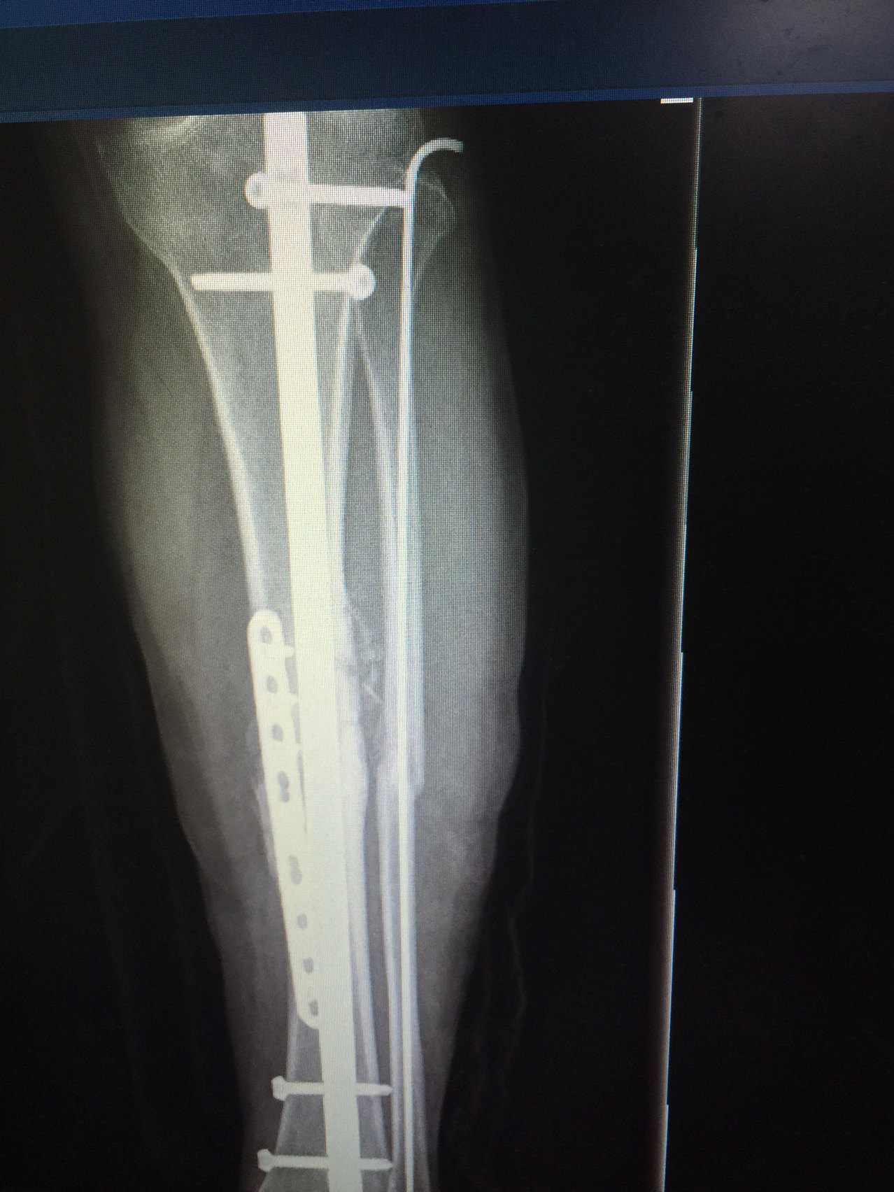 骨折不愈合手术后出院了 骨折不愈合手术后出院了