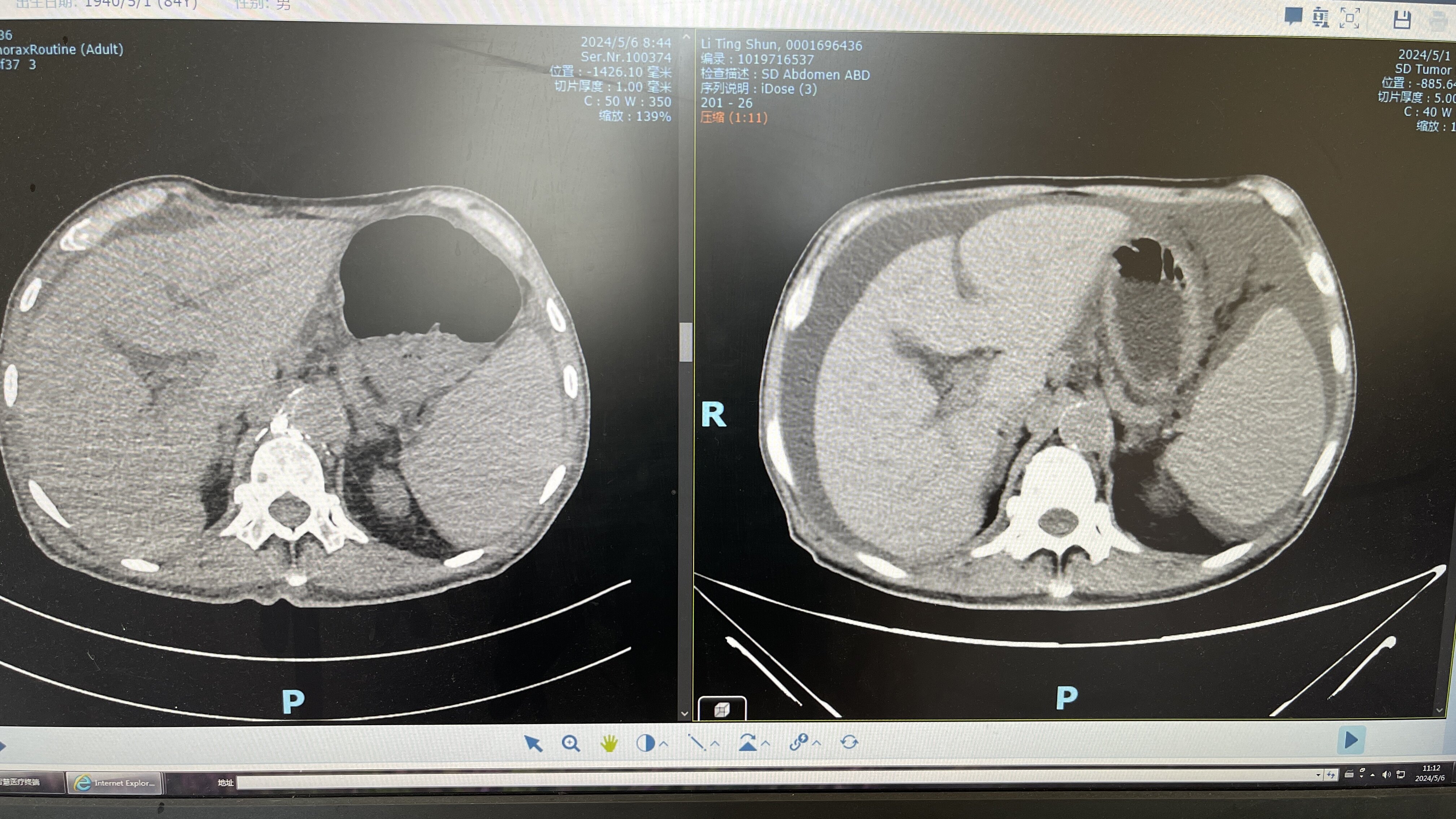 全身水肿伴乳糜腹又是胸导管阻塞惹的祸