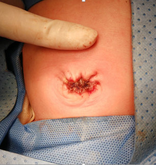 "准爸妈不要慌"系列之脐膨出新生儿期手术治疗