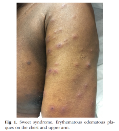 sweet综合征 急性发热性嗜中性皮病 名字很甜,其实很复杂 :病因,病理