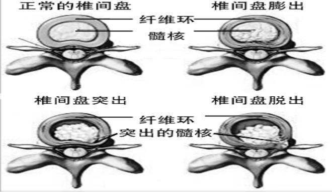 因為科學儀器也不是萬能的,比如椎體小關節紊亂及椎體周圍軟組織的