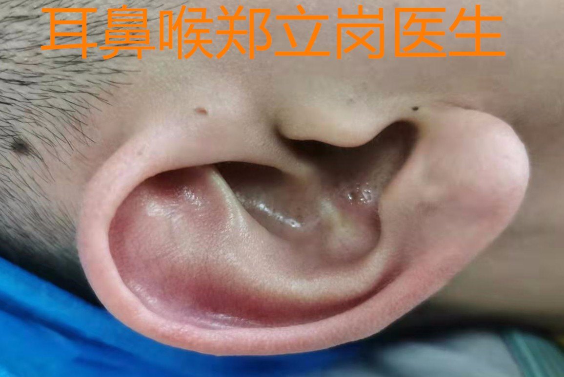 先天性耳前瘘管要彻底根治需手术