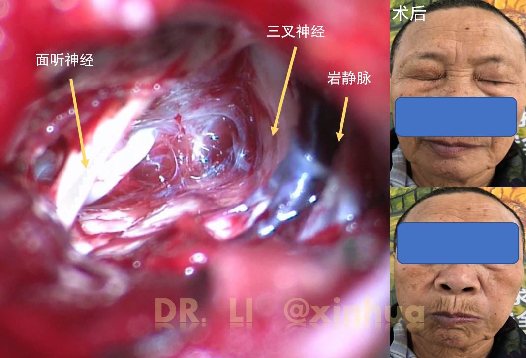 老年患者桥小脑角肿瘤的手术治疗_脑肿瘤_脑肿瘤相关疾病 - 好大夫