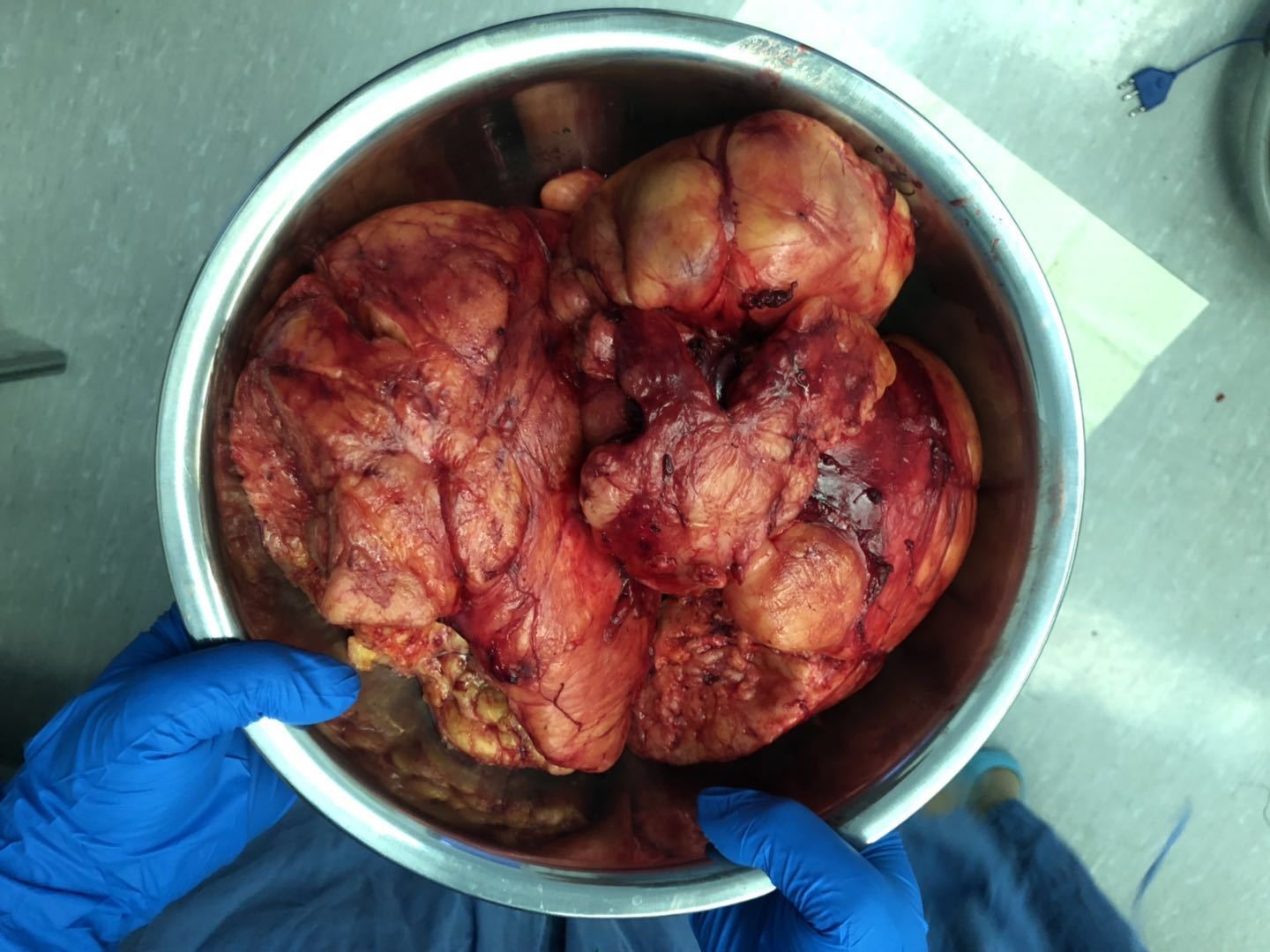 我的手术案例九:巨大右肾错构瘤(25cm)行开放保留肾单位的错构瘤切除