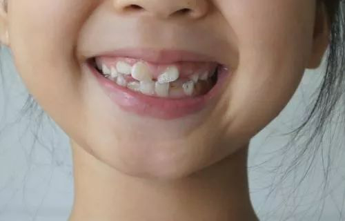 因此,当前门牙两边的牙,即侧切牙和尖牙(又称虎牙)萌出后,中间的间隙