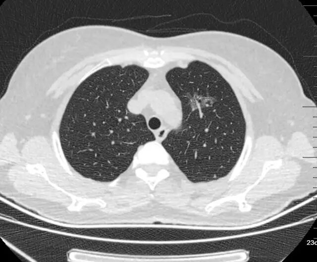 磨玻璃结节 磨玻璃结节