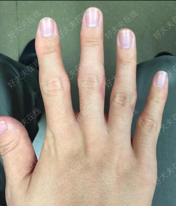 治疗后30天治疗后患者多个手指近侧指间关节粗大,影响外观,无明显活动
