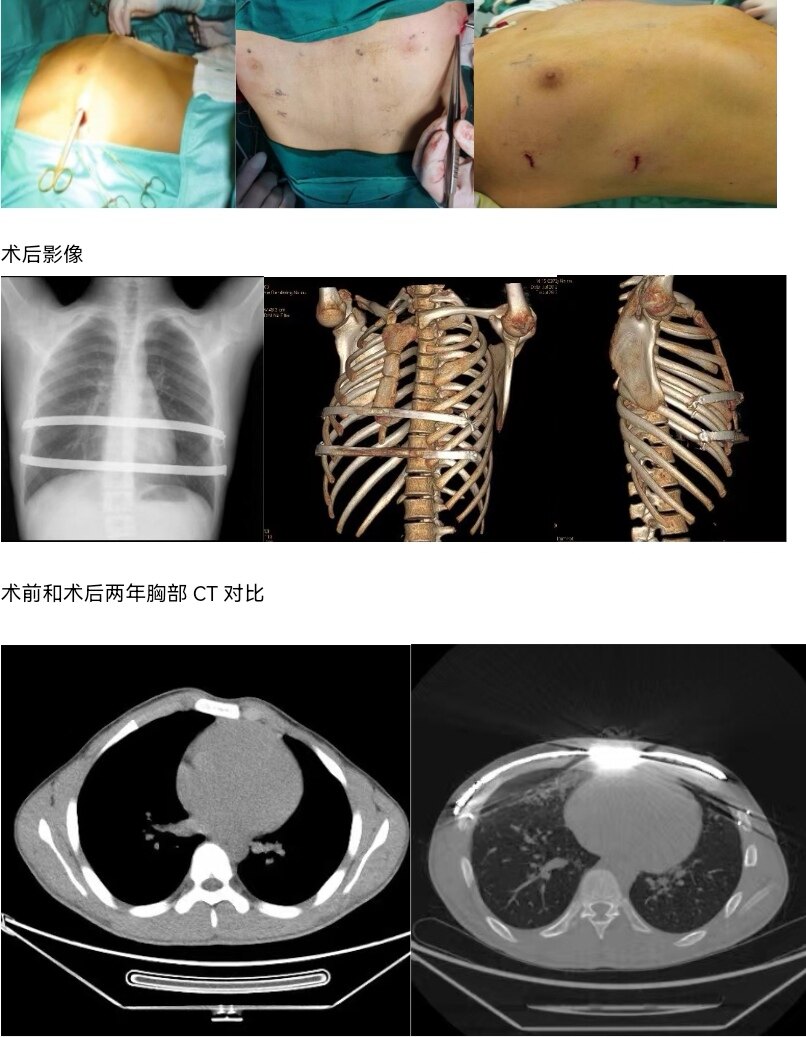 鸡胸和正常胸照片对比图片