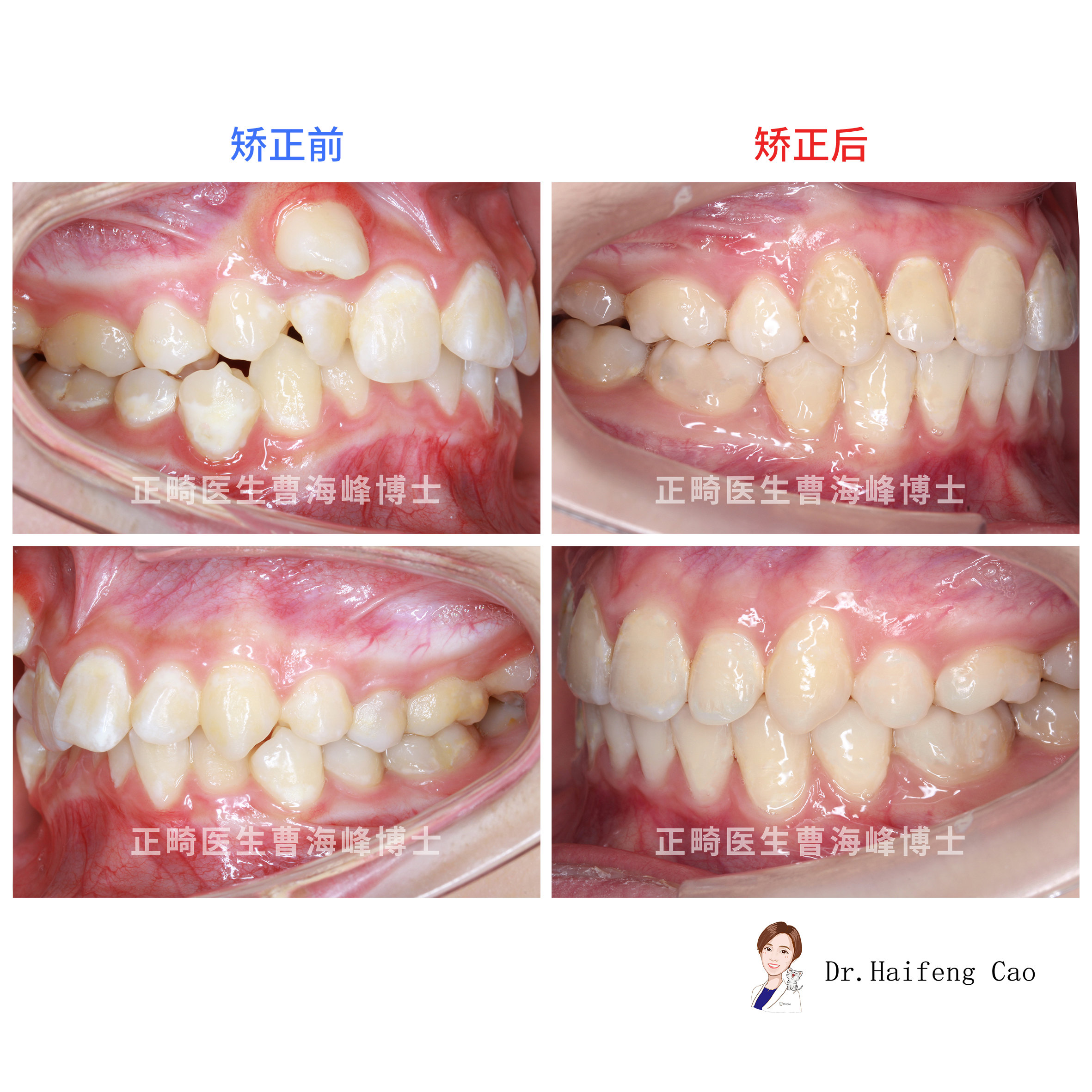 牙齿拥挤牙不齐矫正案例