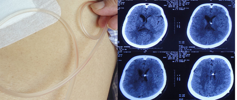 腦室引流又致反覆3次難治性顱內感染和腦積水 在腦脊液科偏癱也近全