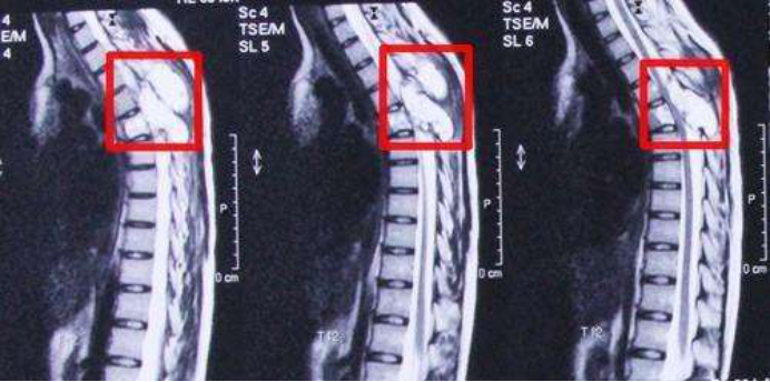 骨癌脊脊柱骨癌图片图片