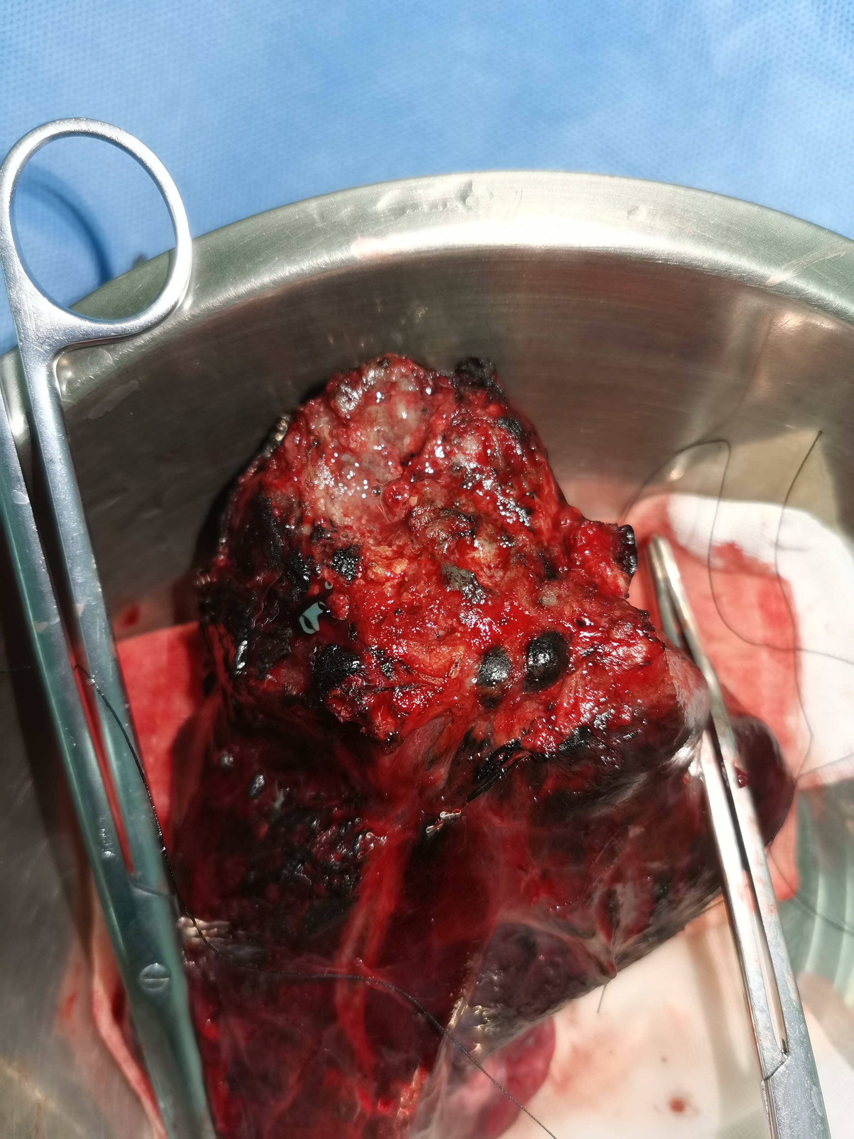 肺部肿瘤巨大侵犯大血管大气管就不能手术了吗?
