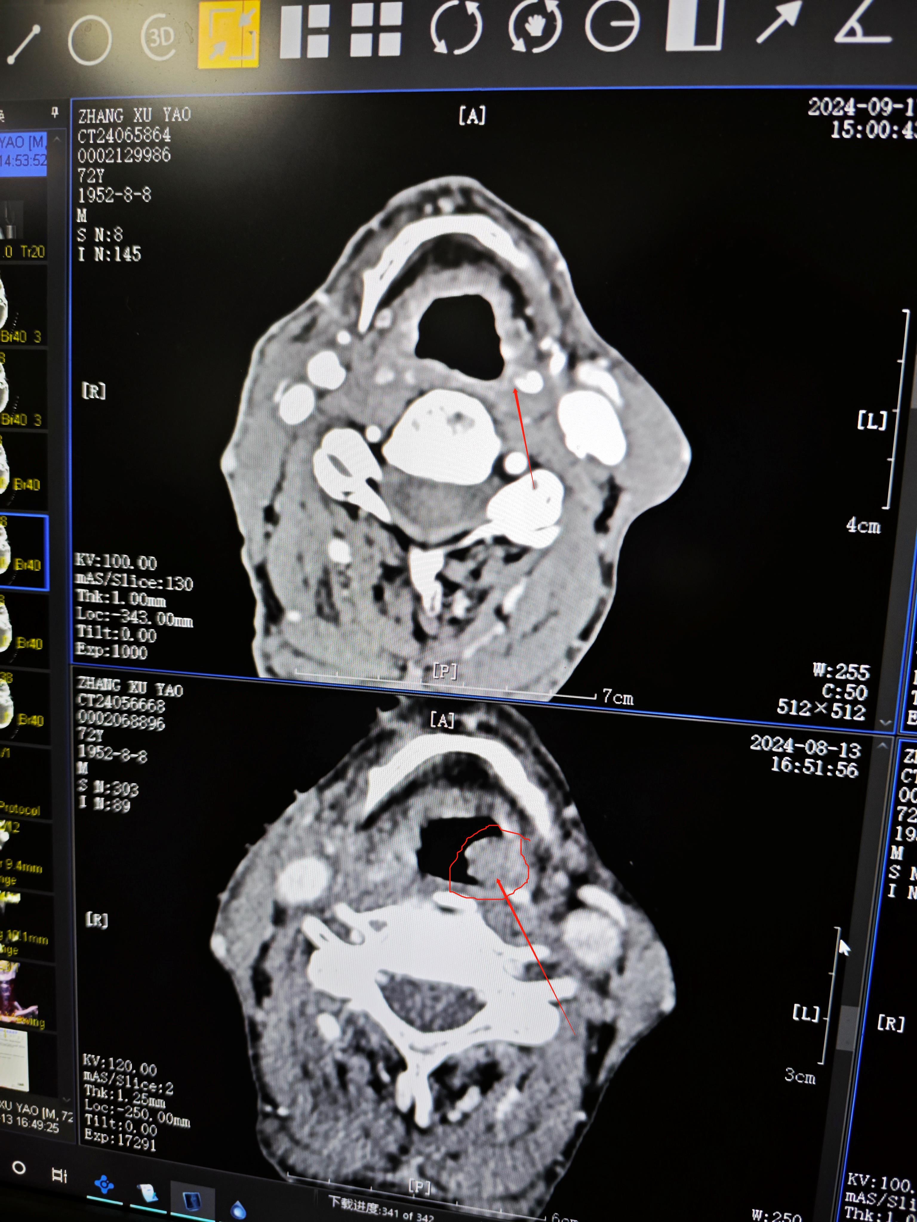 下咽癌以局部治疗为先导的综合治疗