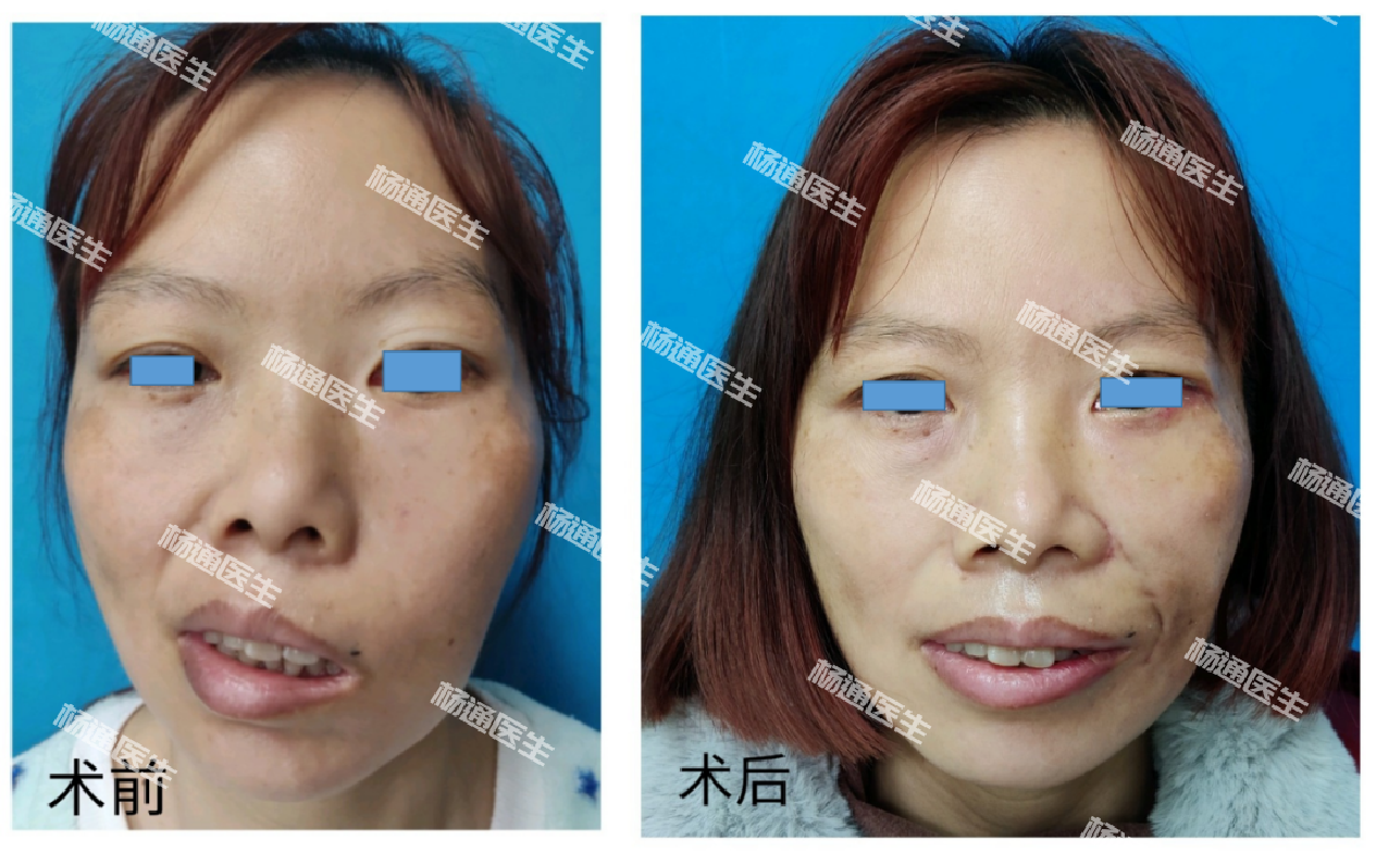 面瘫后遗症怎么办?_面瘫 - 好大夫在线