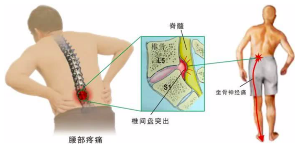 腰间盘突出哪里疼图片图片