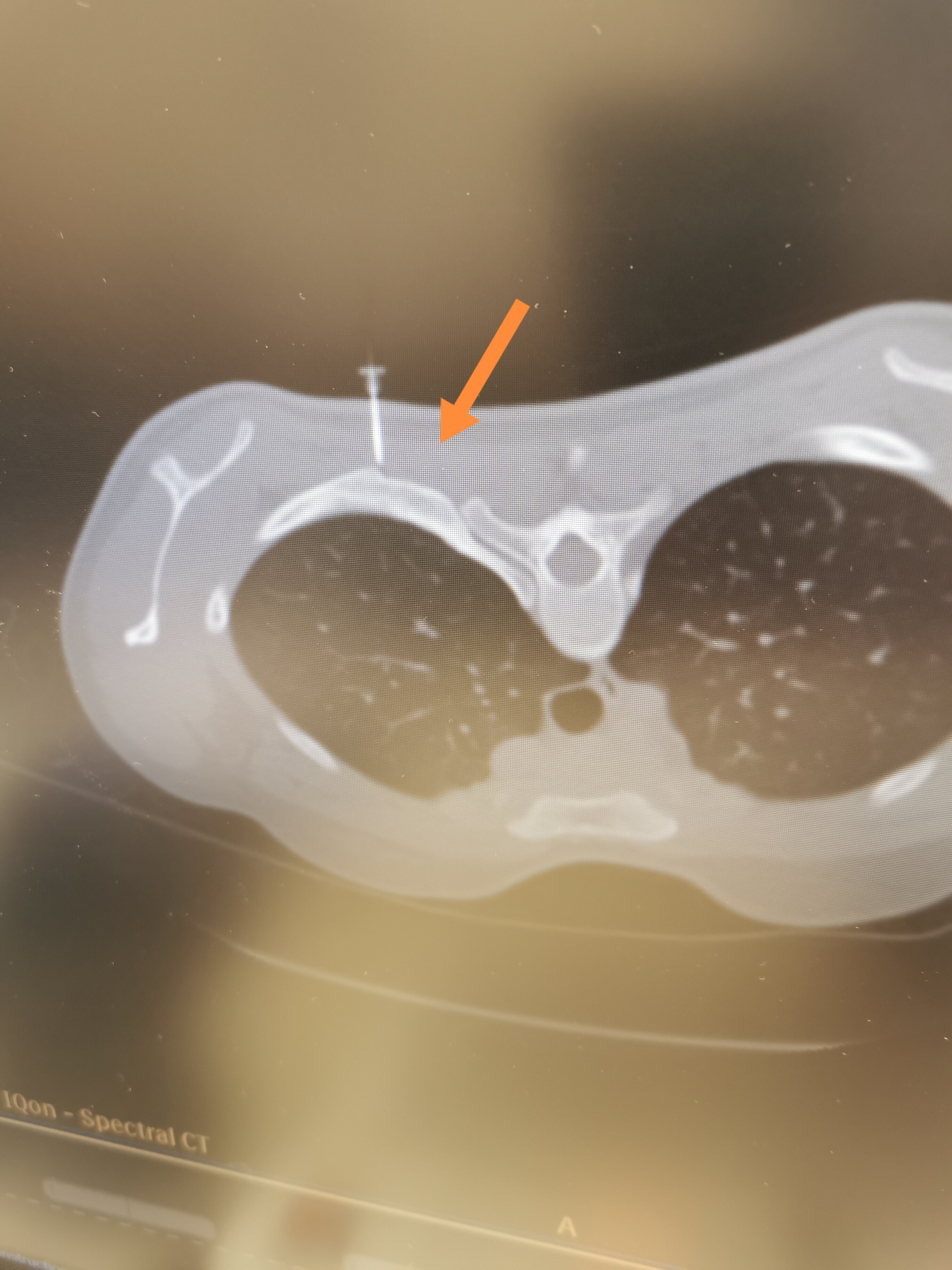 ct引导下经皮穿刺定位(术前定位技术)