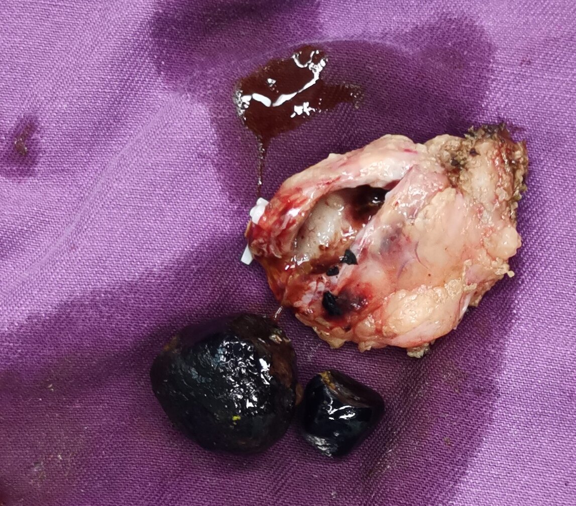 腹腔镜下残余胆囊切除 - 好大夫在线