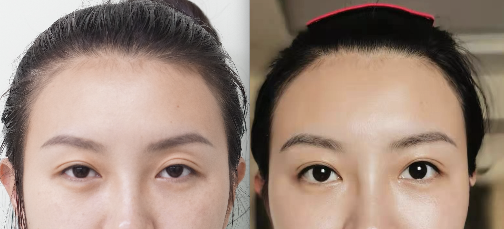 这种微创手术的方法是在上眼睑结膜位置做一个小切口,通过小切口直接