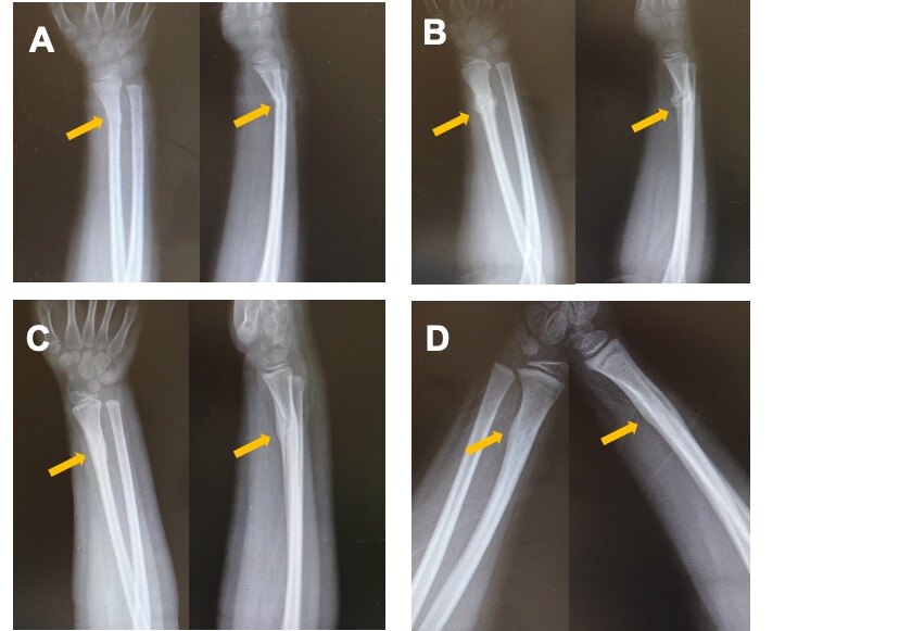 小儿骨折_小儿骨折治疗方式 - 好大夫在线