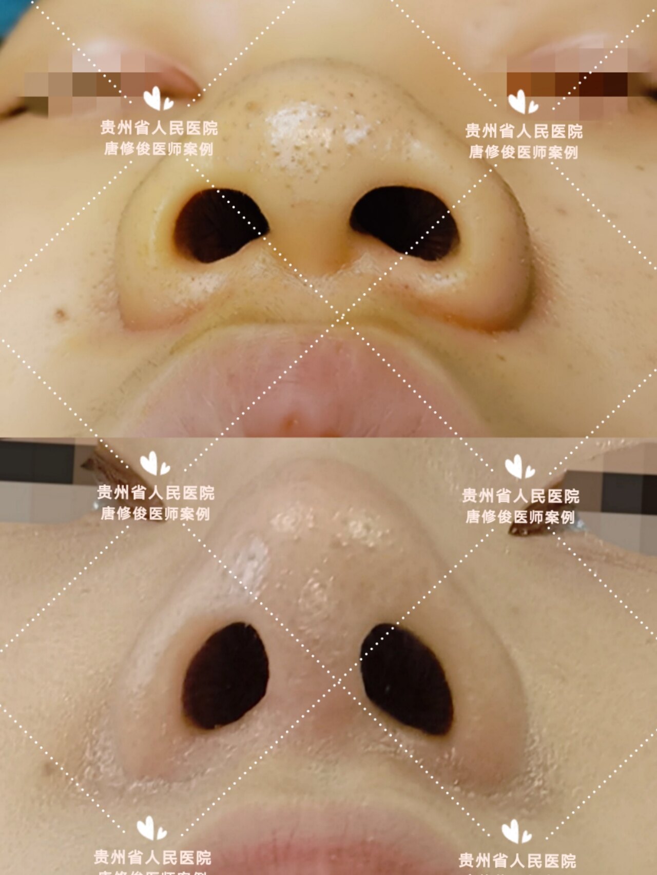 缩鼻翼会留疤吗图片