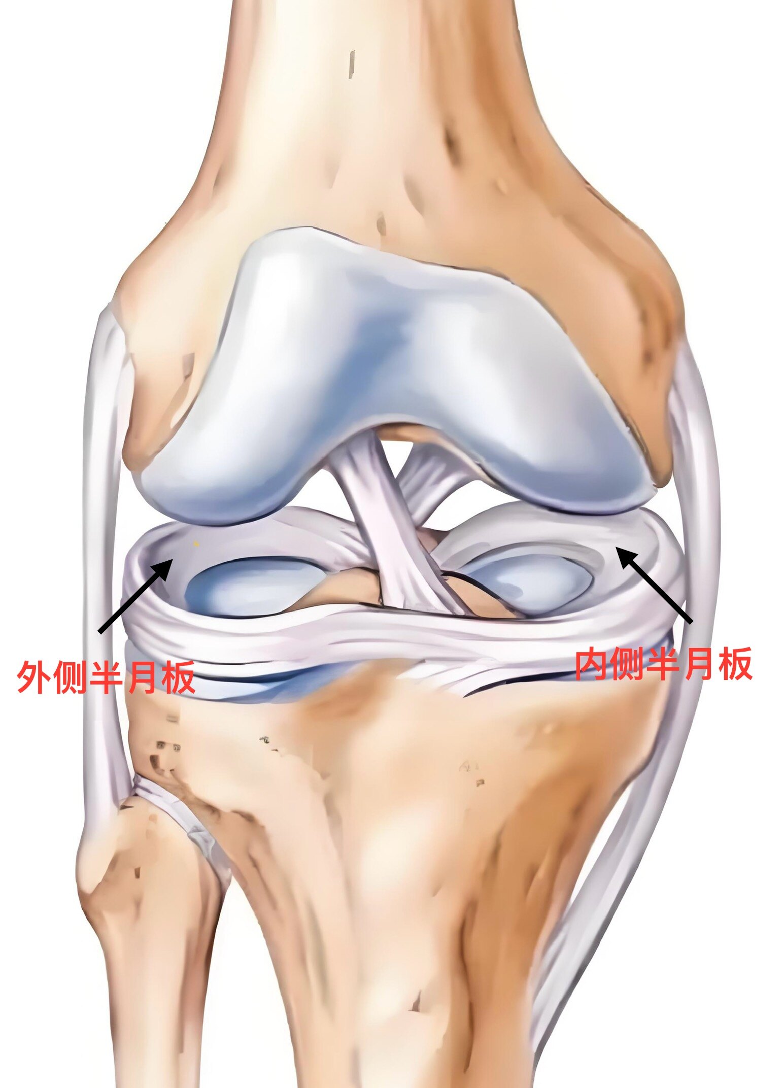 膝关节半月板损伤了怎么办?