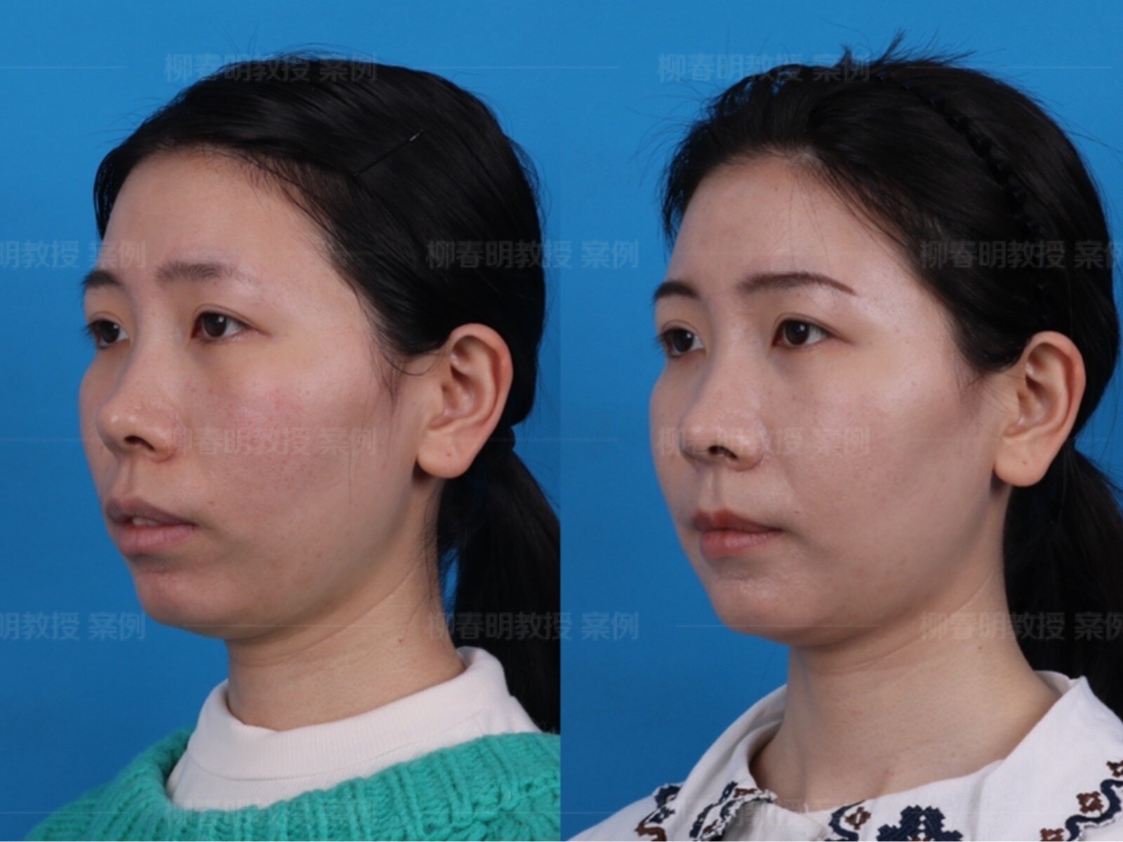 【正颌手术案例分享】双颌前突矫正术(照片为案例,我院拥有肖像使用权