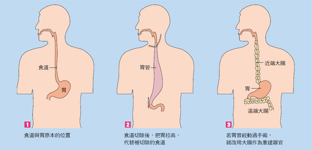 2019版csco食管癌诊疗指南