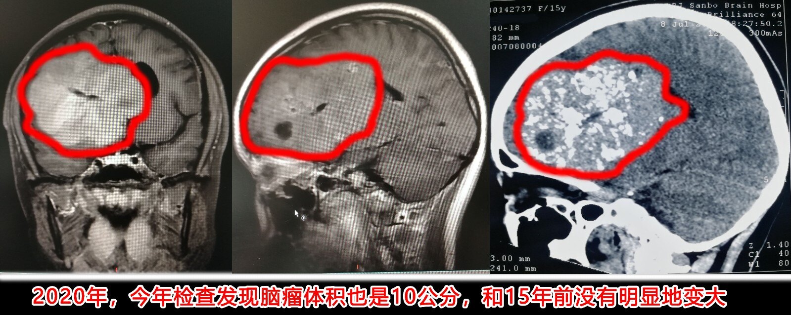 半岁发现10公分巨型脑瘤15年后才想着手术切除有这样的事情吗