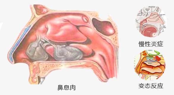 鼻息肉会出血吗图片