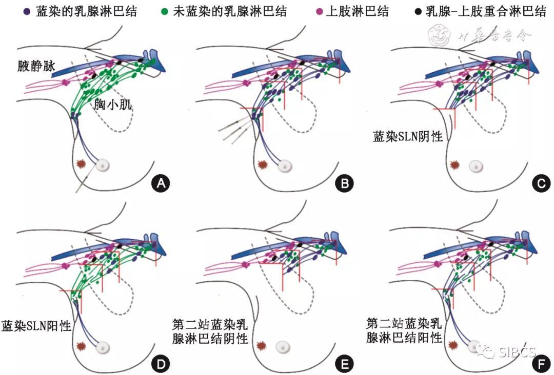 乳腺癌腋窩淋巴結功能分區清掃術